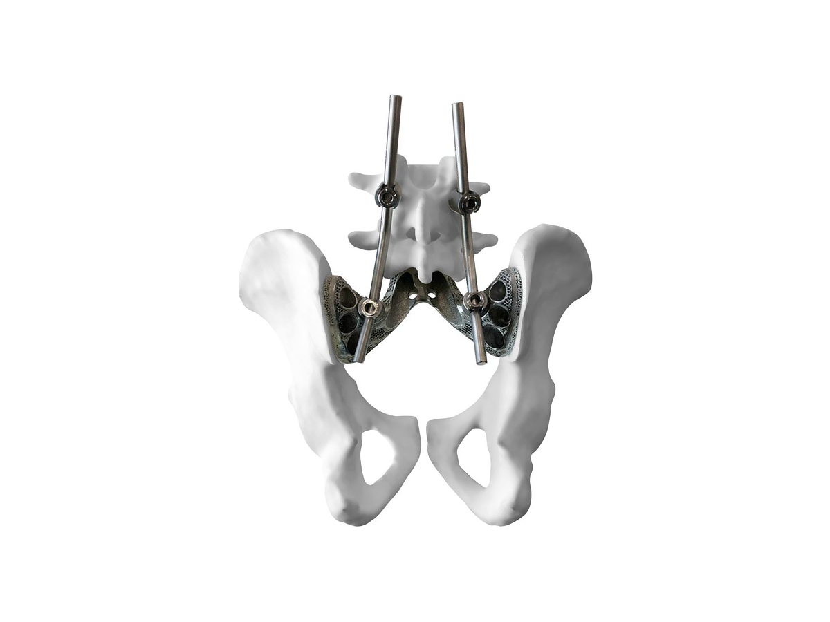 Precision Titanium 3D Printing: Complex Geometries with Superior Strength Medical Implants